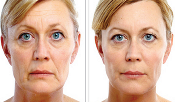 wrinkle treatment in Delhi