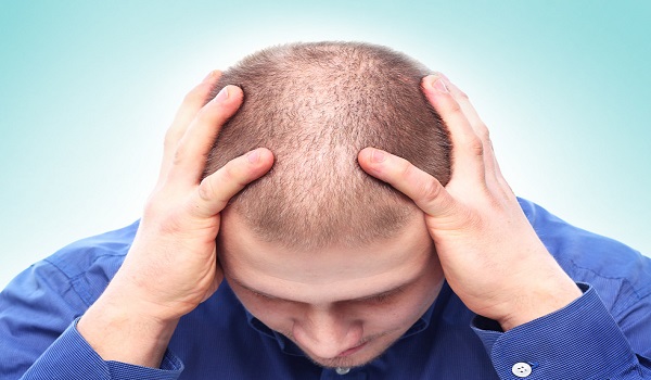 hair loss treatment in Delhi