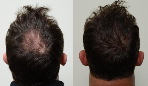 PRP hair treatment in Delhi