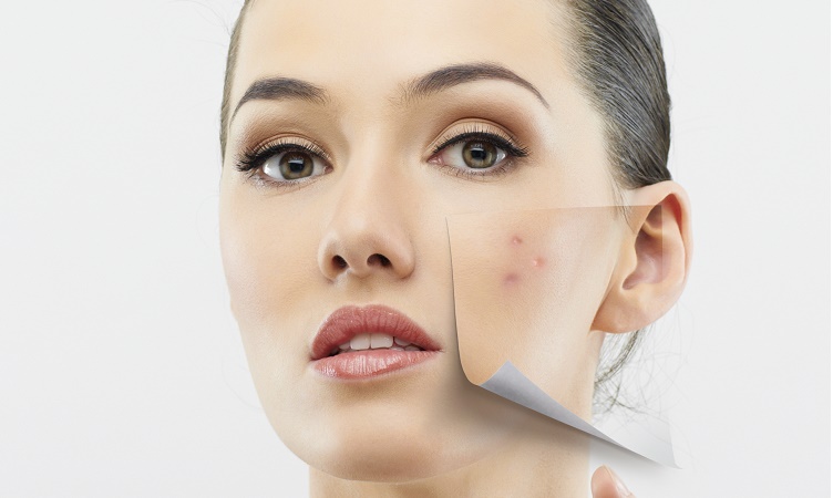 why acne return and how to stop acne cycle